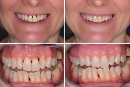 CollaGum - Recupera tus encías y tu sonrisa en 21 días
