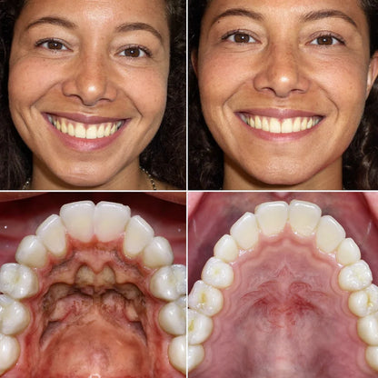 CollaGum - Recupera tus encías y tu sonrisa en 21 días