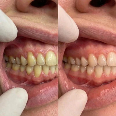 CollaGum - Recupera tus encías y tu sonrisa en 21 días