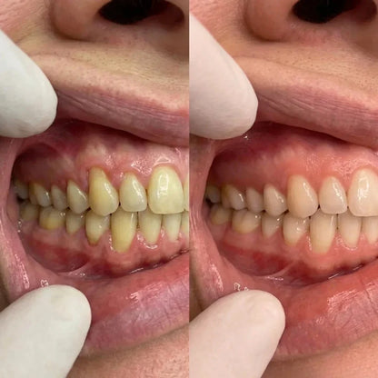 CollaGum - Recupera tus encías y tu sonrisa en 21 días